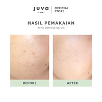 ACNE DEFENSE SERUM-thumb-3